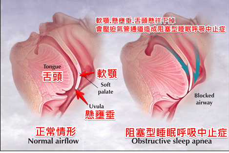 軟顎.懸壅垂.舌頭懸往下掉會壓迫氣管通道造成阻塞型睡眠呼吸中止症